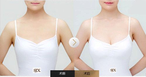 胸部下垂老公能帮忙恢复吗,男性胸部下垂的拯救方法