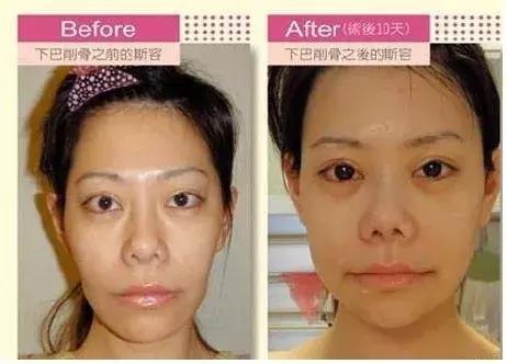 花百万整形60多次被嘲青蛙脸，这个台湾女主持真豁得出去