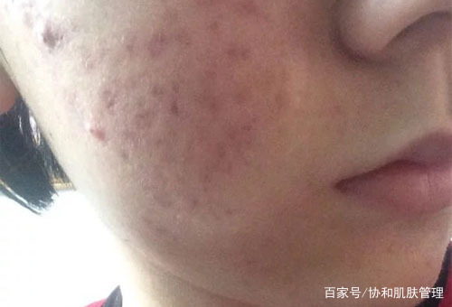 怎么有效的修复脸上的痘坑痘印,什么膏药能够治疗脸上的痘坑痘印