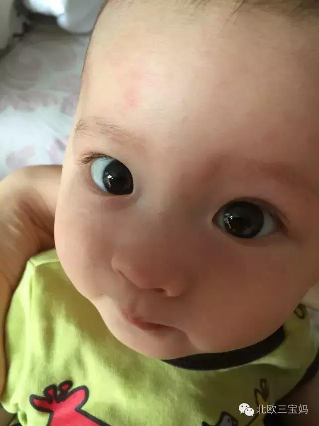 儿童急疹科普,宝宝湿疹和热疹的正确护理方法