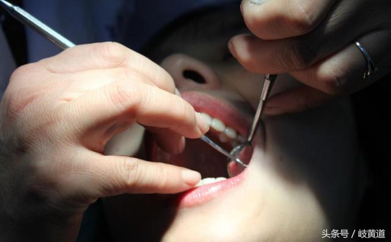 补牙一定要杀死牙神经吗,为什么补牙要杀死牙神经才能补