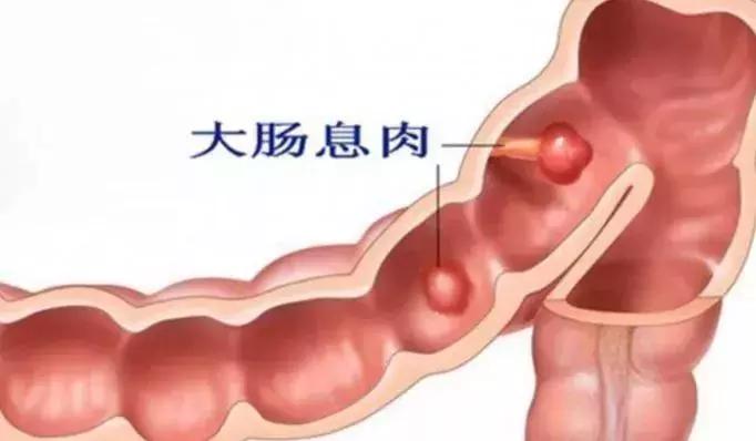 结节息肉囊肿缠身老中医教你一招,中医调理结节囊肿息肉体质