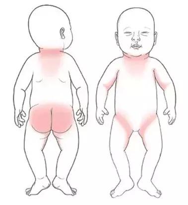 宝宝湿疹终于好了,宝宝湿疹治愈经历