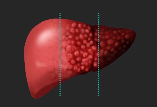 确诊肝硬化后来再检查就好了,医生能看出肝硬化吗