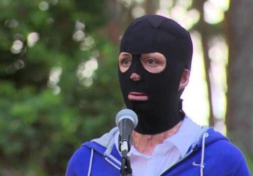 弹力衣治疗疤痕使用方法,陈旧性疤痕用弹力套有用吗