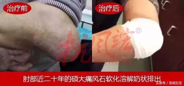 痛风久治不愈怎么办,痛风久治不愈就差在这一步上