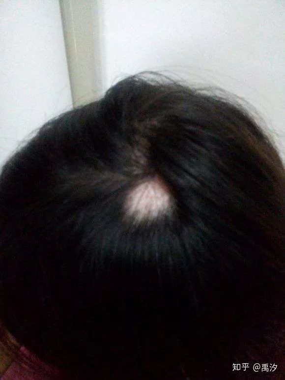 我们年轻人脱发,当代年轻人普遍脱发的原因