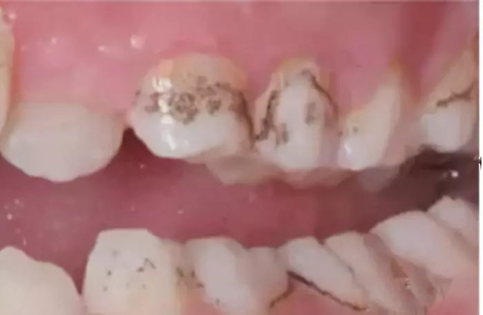 2岁宝宝牙齿全烂光，这5个问题不及时处理，孩子将来恨你一辈子