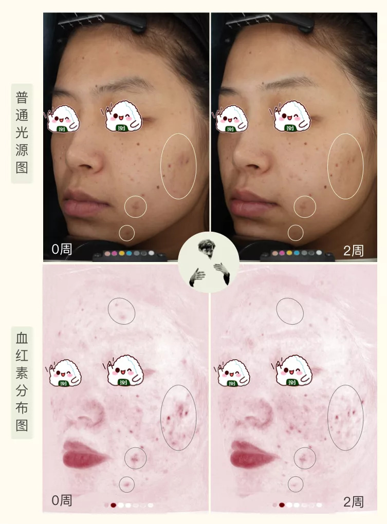 30天花80块去掉陈年老痘印到底有没有可能？