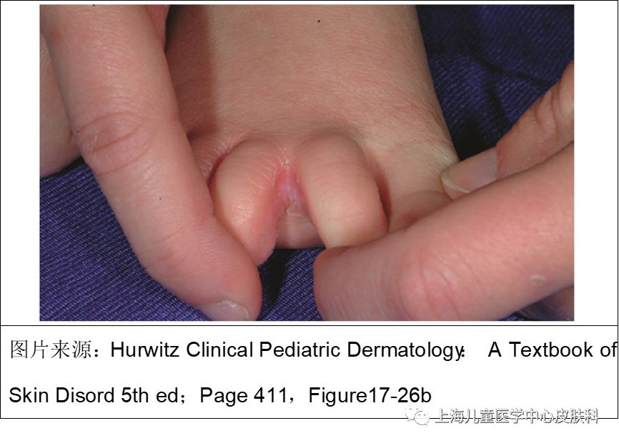 一岁宝宝有脚气怎么办,宝宝怎么会得脚气