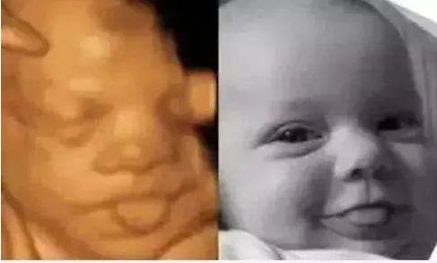 产检4维彩超需要注意什么,4维彩超能做出的畸形有哪些