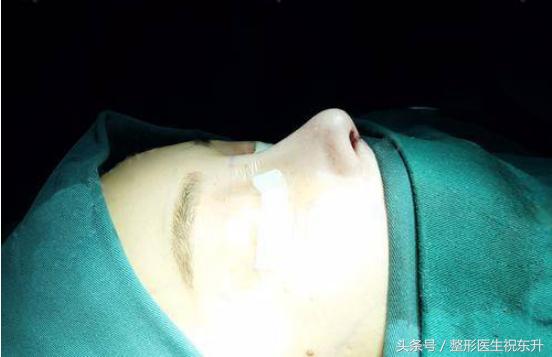 为什么有的人隆鼻成功有的失败,揭秘医生都不会说的隆鼻内幕