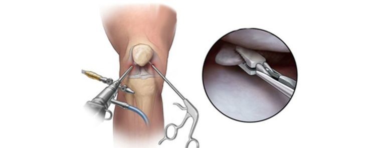 关于半月板的正确说法,半月板前世是什么
