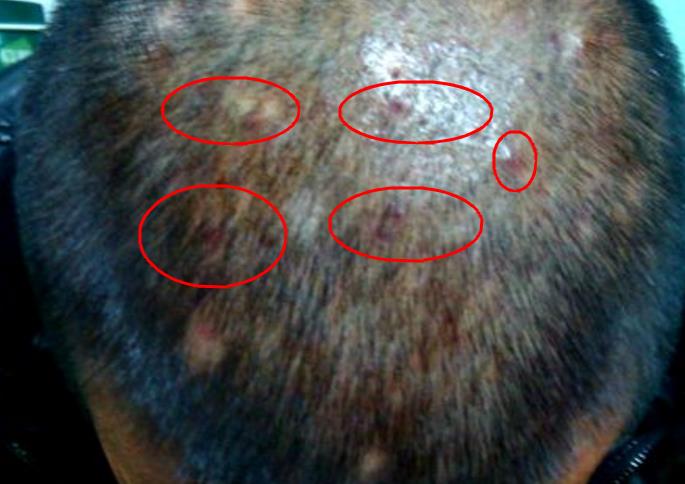 怎么除头螨虫最有效方法,头上螨虫怎么去除简单方法