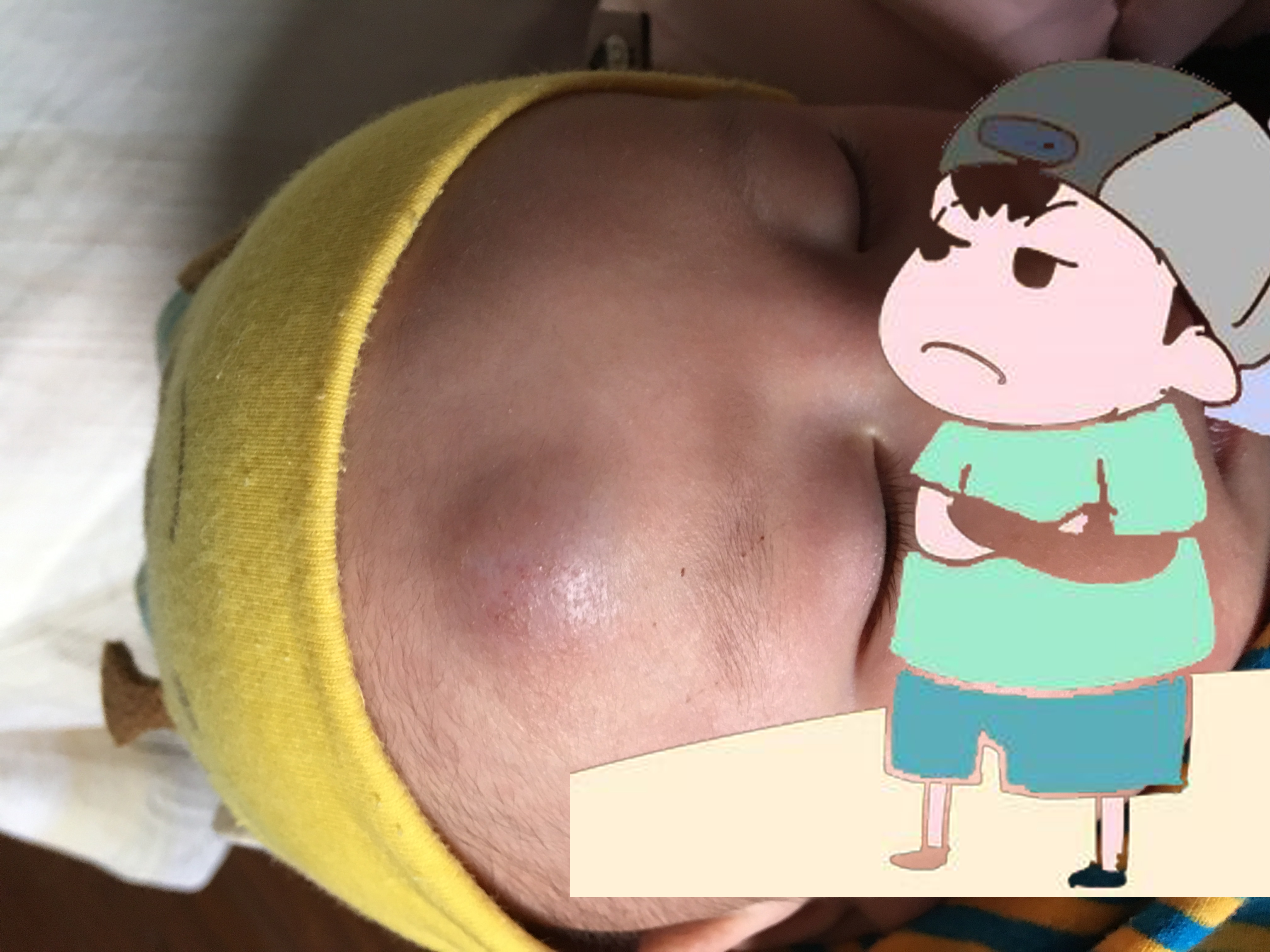 婴幼儿血管瘤怎么治疗效果好,婴幼儿血管瘤最好的治愈方法