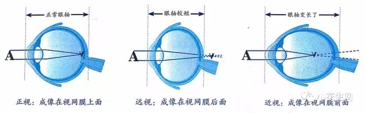 儿童近视7种早期症状,儿童近视的4大早期表现