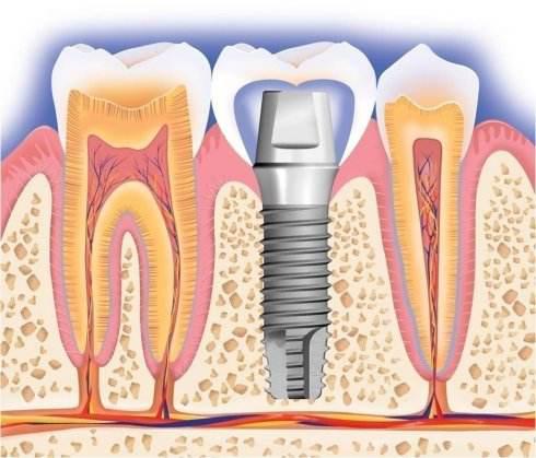 带您了解牙齿,种植牙科普30秒