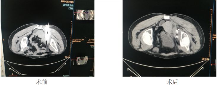 碘125粒子植入术教授,碘125粒子植入术引入中国