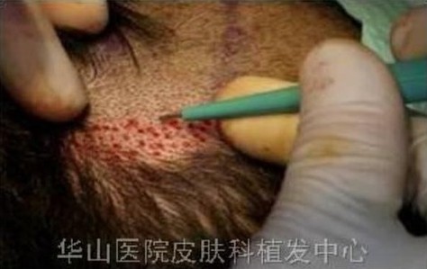 5个男人1个秃？快来了解雄激素性秃发的综合治疗