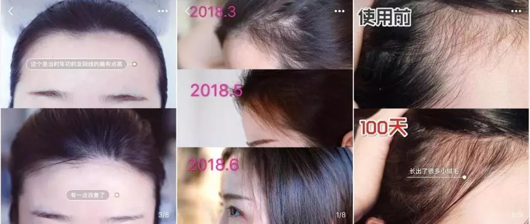 万事屋推荐|不想变秃的十二星座,这可能是目前为止世界上最有效的生发方案