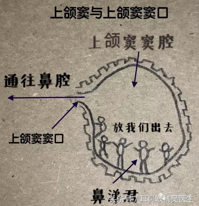 鼻炎鼻窦炎鼻息肉有什么区别,鼻炎和鼻窦炎究竟有什么区别