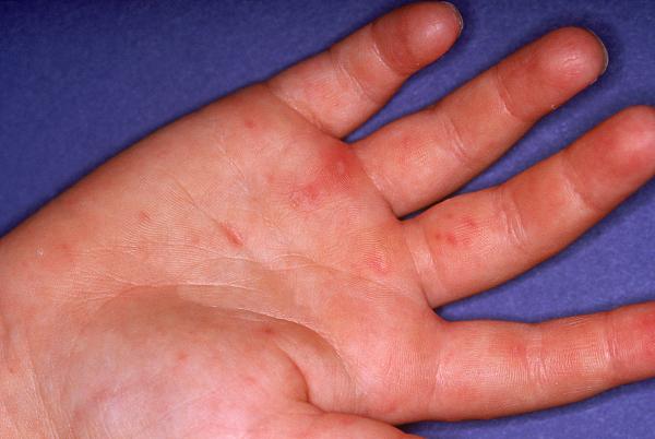 家长注意这种传染病已进入高发期,提醒家长注意疾病