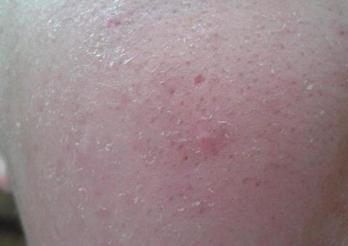 床上螨虫多?需一片叶子,不到1块钱,螨虫有多少死多少