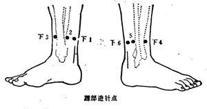 中医针刺绝招大全,针灸腕踝针位置示意图