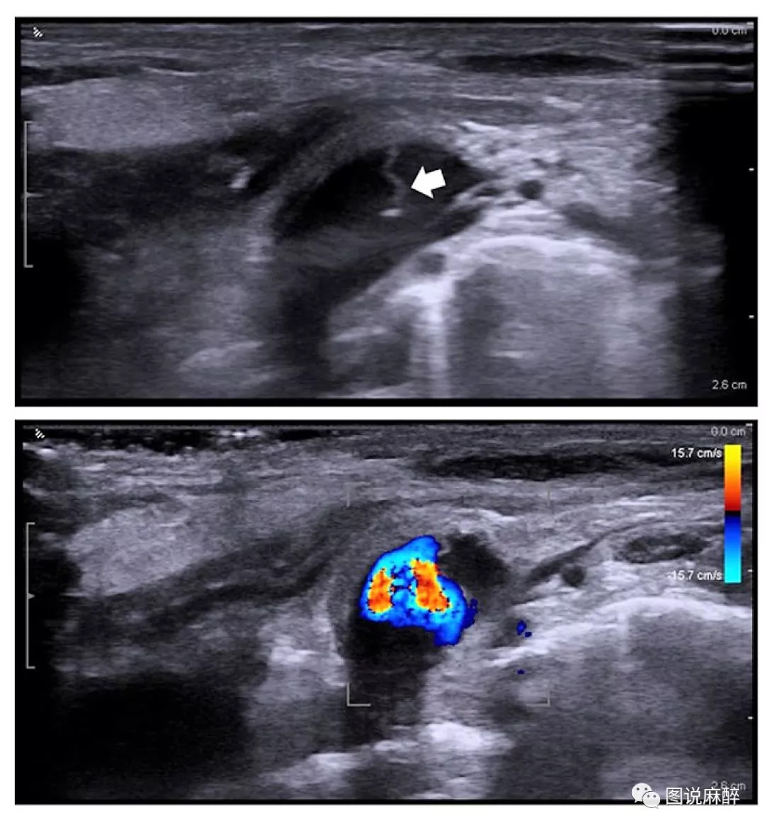 深静脉穿刺置管术拔出后疼痛,深静脉穿刺置管深度一般多少厘米