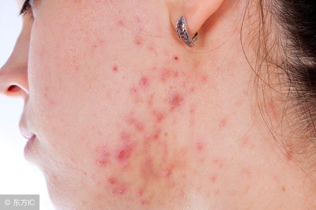 后背螨虫怎么去除最快方法,后背的螨虫和痘痘怎么去掉