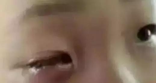 食品干燥剂遇水爆炸伤眼睛图片,误吞干燥剂眼球被溶化