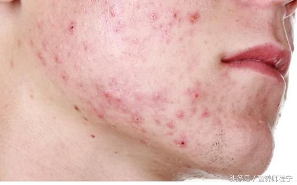 不同的部位长痘该如何解决呢,痘痘怎么才能不反复长痘