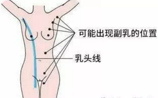 产后副乳怎么消除才正确,产后副乳是什么原因造成的