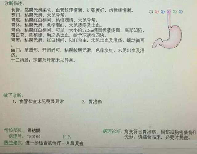 胃溃疡性质病变是指什么呢,胃溃疡的病因是什么如何治疗