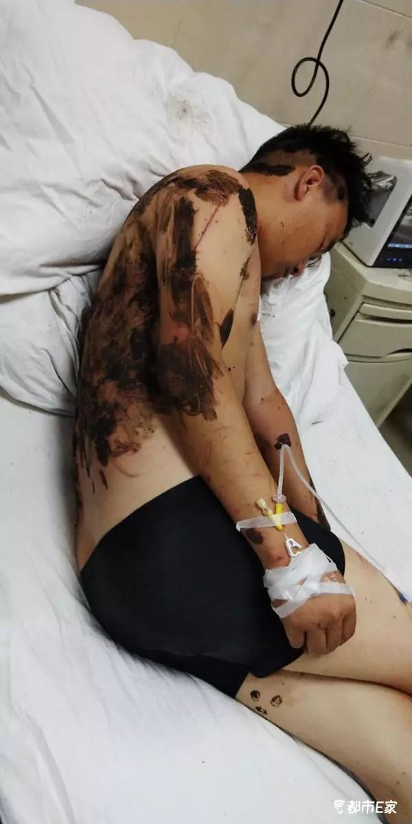 被马蜂蛰了怎么救治,男子被马蜂蜇伤146处伤