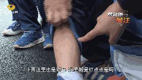 8岁男孩被仓鼠咬伤有没有大碍,小孩被宠物仓鼠咬出血怎么办