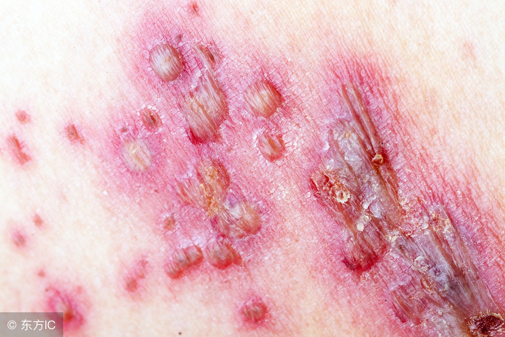 病毒性疱疹是怎么传染的呢？有哪些注意事项