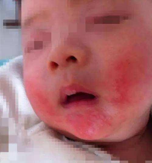 宝宝湿疹难缠,宝宝湿疹为什么反复发作该怎么办