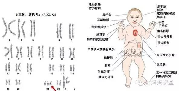 筛查出唐氏儿怎么办,唐氏综合征的宝宝唐筛会过吗