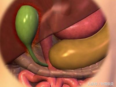 针灸治疗胆囊炎的药方,刘红云老师针灸调理胆囊炎