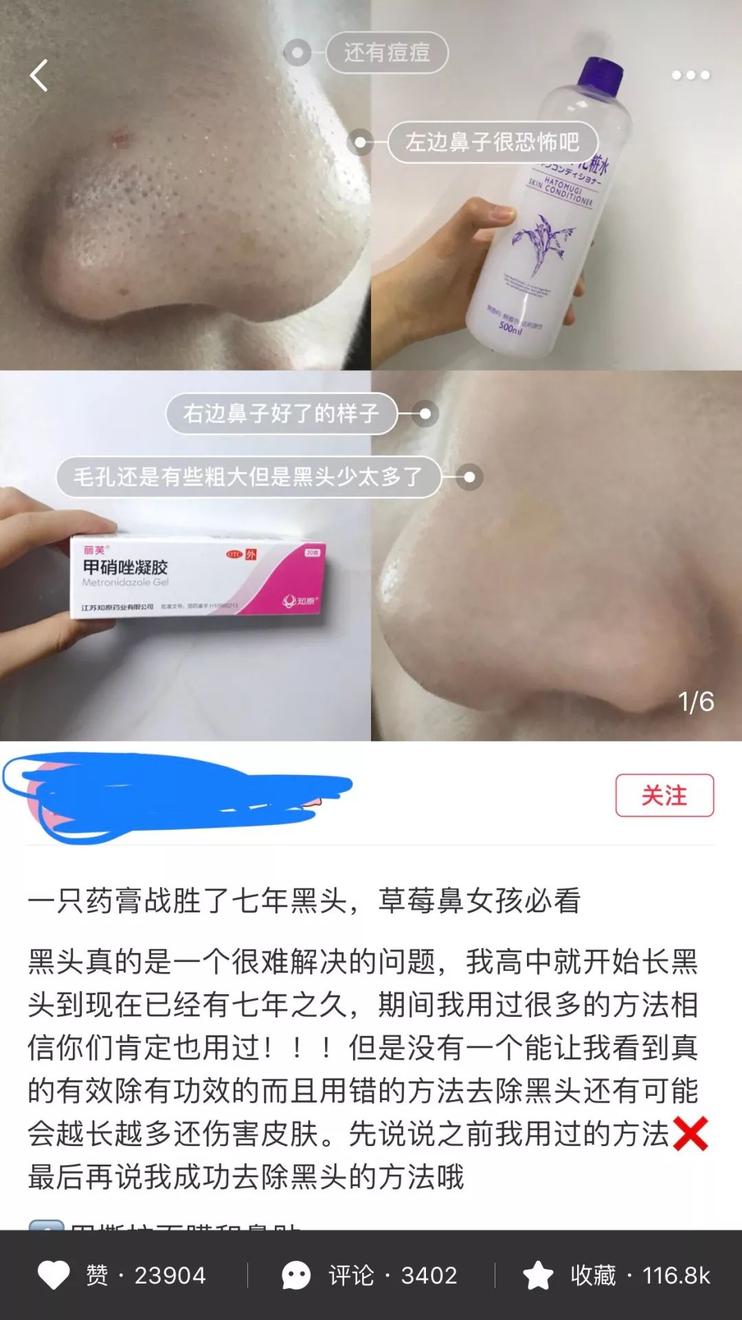 维生素b6能祛闭口改善皮肤粗糙吗,维生素b6祛闭口粉刺收缩毛孔