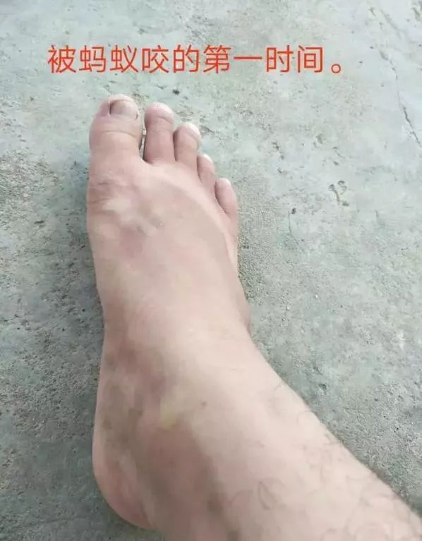 广西蚂蚁咬人事件,广西有种蚂蚁被咬全身痒