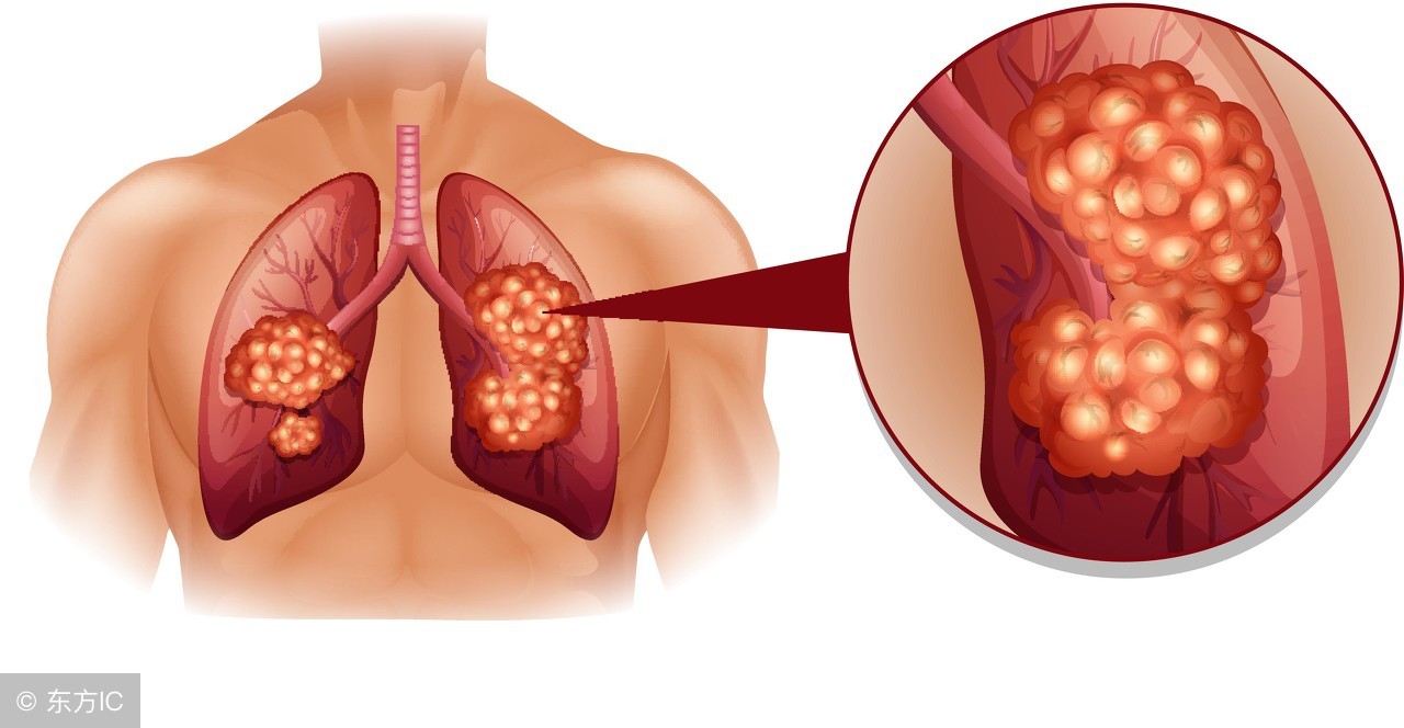 小细胞肺癌晚期在家里怎么护理,肺癌护理查房讨论问题有哪些