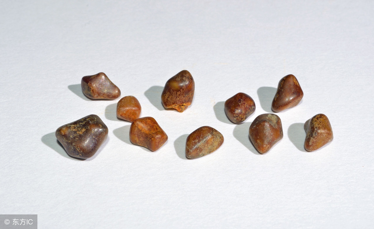 尿结石伴有血尿严重吗,尿结石血尿症状