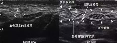 手麻、无力、肌肉萎缩？——你可能得了腕管综合征