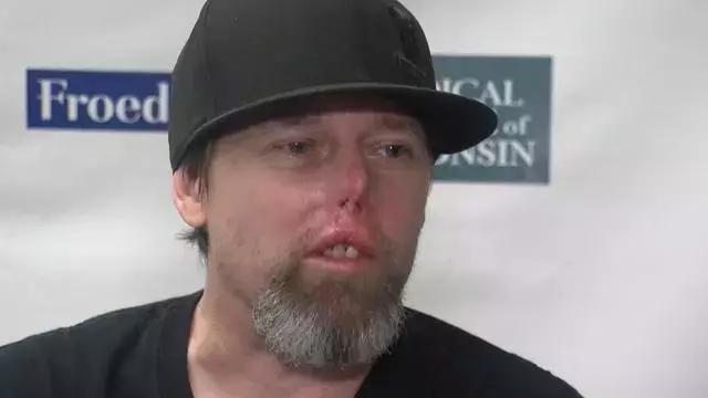 又一例！他严重感染四肢被截，竟只因被狗狗舔了一下……