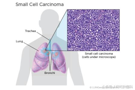 小细胞肺癌2023年新突破,小细胞肺癌重大突破