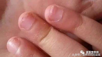 宝宝指甲白斑、凹陷、薄脆、倒刺、分层……原来是这么回事！