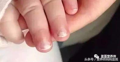 宝宝指甲白斑、凹陷、薄脆、倒刺、分层……原来是这么回事！