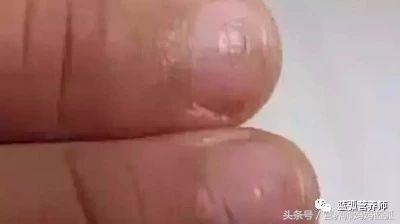 宝宝指甲白斑、凹陷、薄脆、倒刺、分层……原来是这么回事！